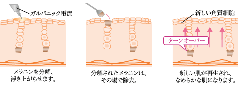 毛穴につまった皮脂やメイク汚れを電気分解