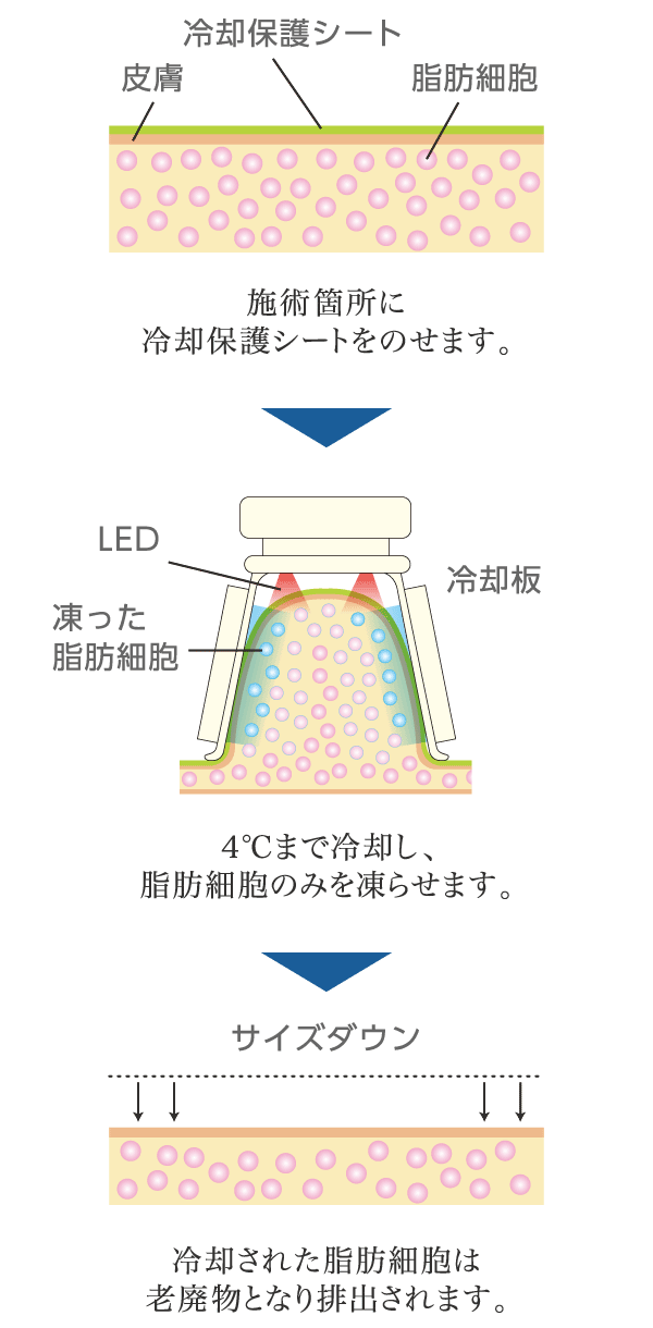 冷却された脂肪細胞は老廃物となり排出されます。